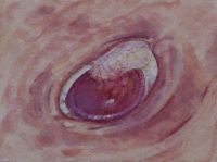 Blister on Eye